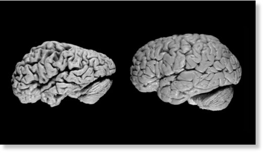 Мозг страдающего от деменции (слева) и мозг здорового человека (справа)