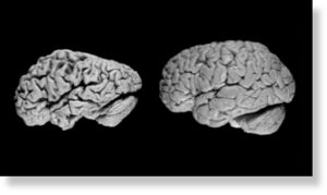 Мозг страдающего от деменции (слева) и мозг здорового человека (справа)