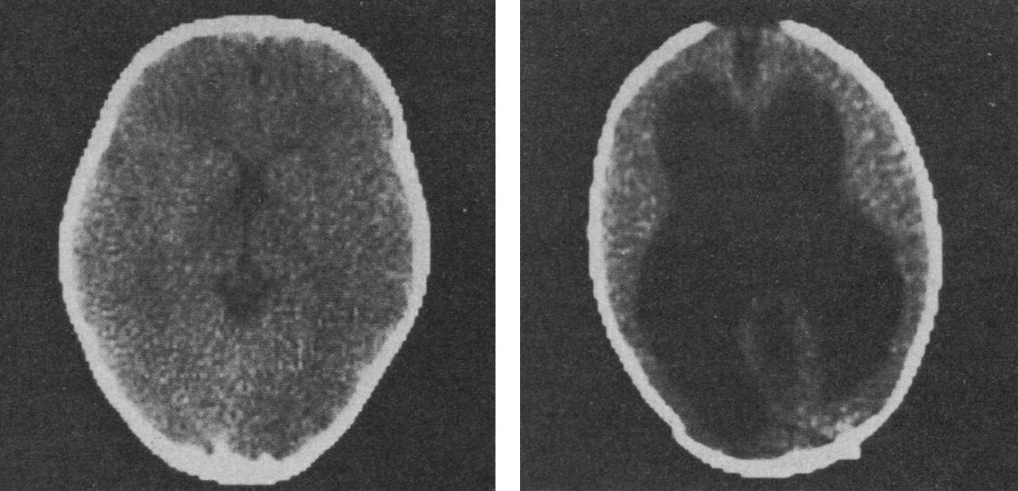 A horizontal scan shows the ventricles as narrow slits in a normal individual (left) and large cavities in a hydrocephalic patient (right)​
